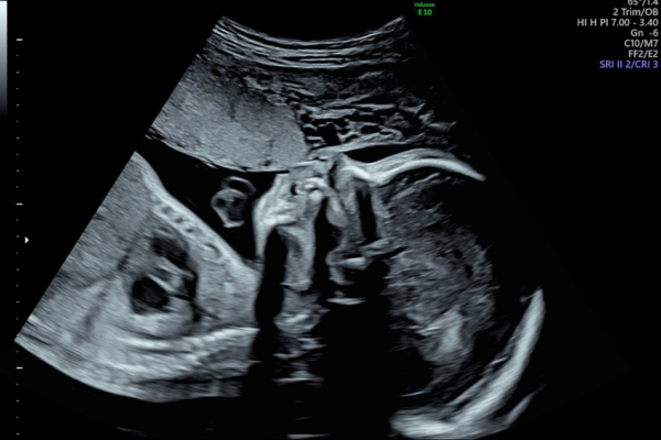 Ultrasound Anomaly Scans