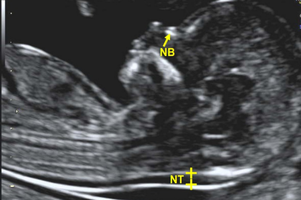 Ultrasound NT Scan