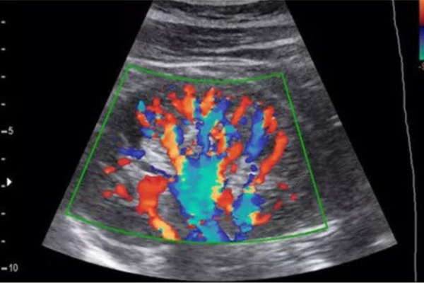 Color Doppler Ultrasound in Pimpri 