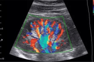 Colour Doppler Test in Pimpri-Chinchwad displaying real-time vascular blood flow scan